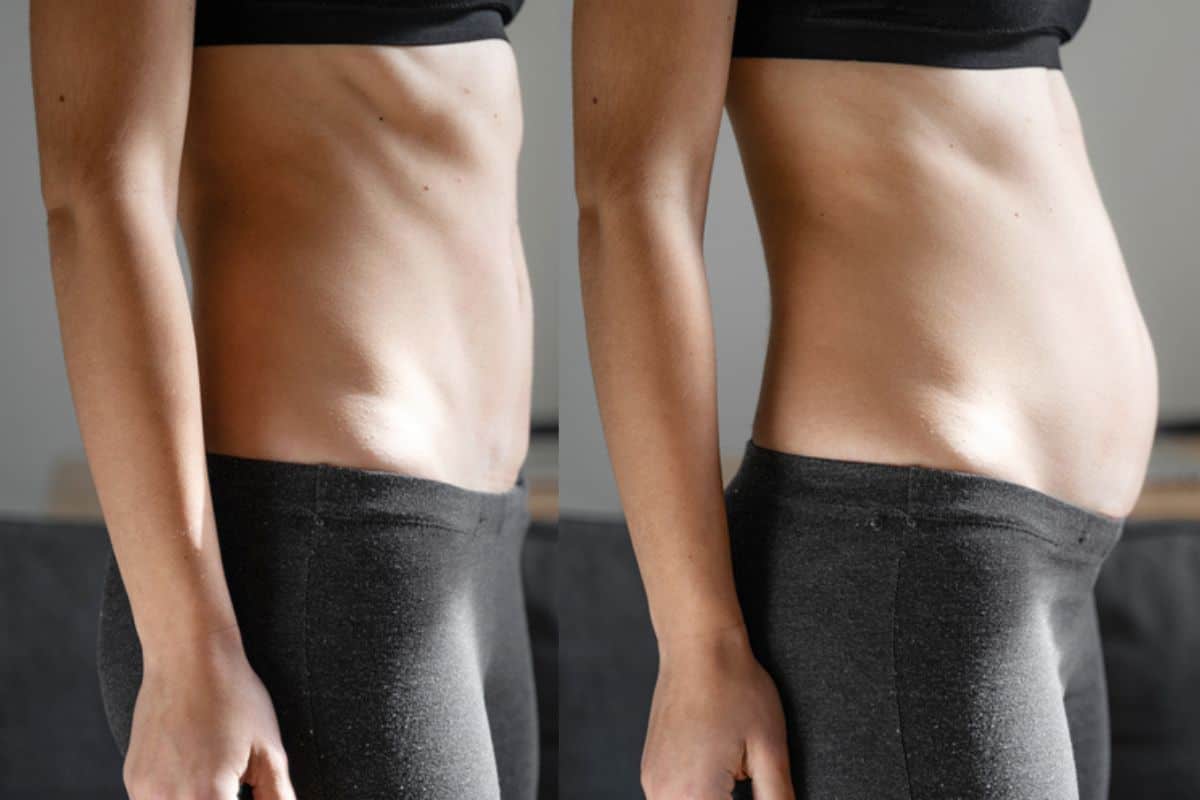 How long does diastasis recti take to improve Frimley?